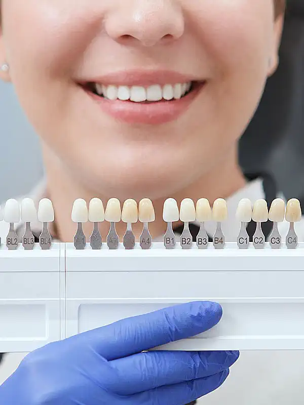 Dental Veneers (Hollywood Smile) Dental Veneers (Hollywood Smile)
